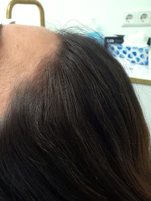 Haar na de mesotherapie: voller bij de scheiding