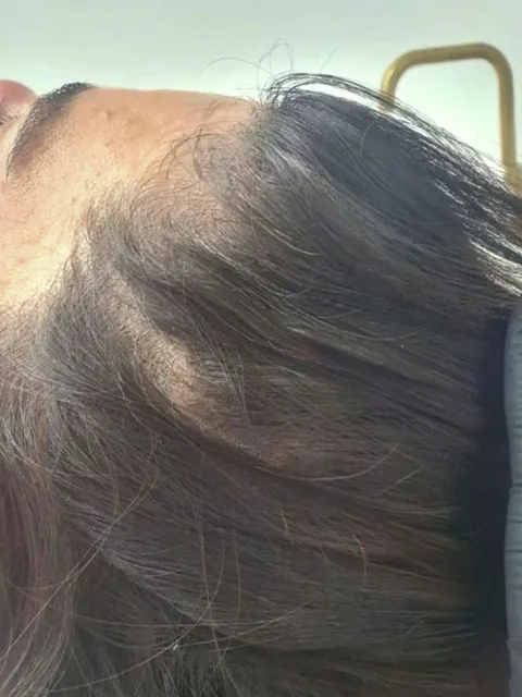 Haar voor de mesotherapie: dun bij de scheiding